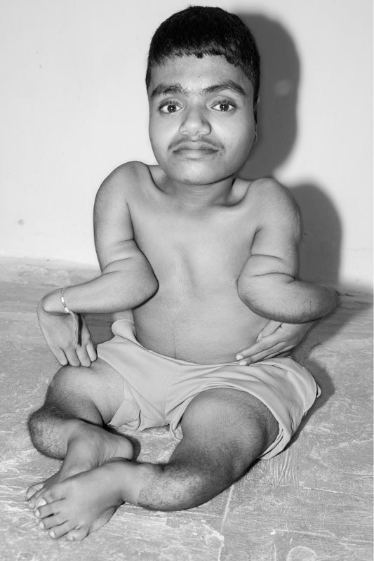 A young man handicapped by skeletal fluorosis due to long-term exposure to high fluoride in drinking water in Nalgonda district, Telangana